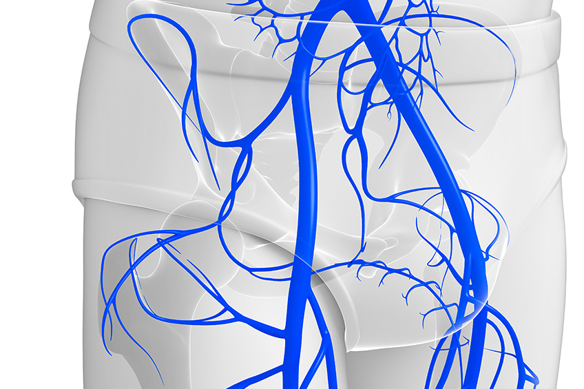 varices pelviennes